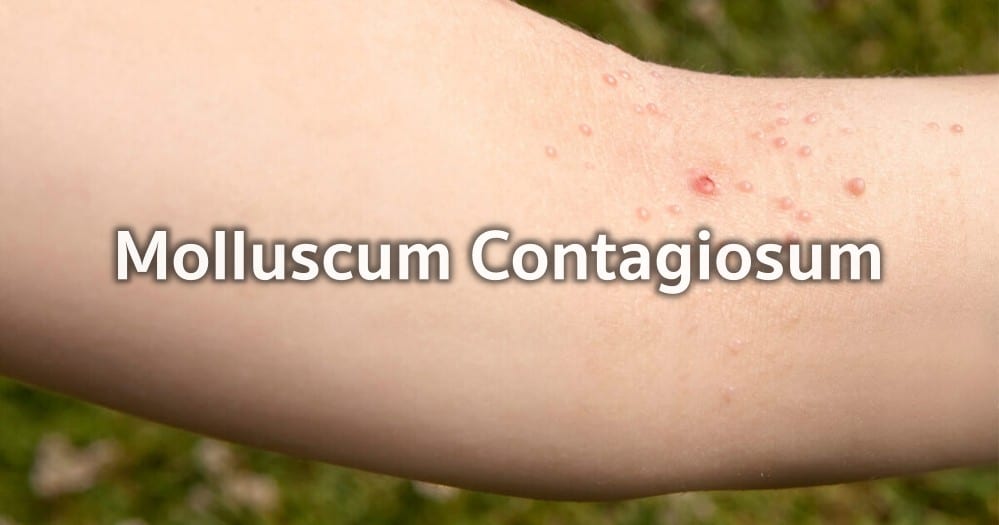 Molluscum Contagiosum Explained: Symptoms, Treatment, and Prevention